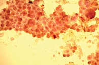 Рис. 5. Мокрота. Положительная ИЦХ-реакция на MUC-1 в клетках опухоли (окраска по Романовскому – Гимзе, 20-кратное увеличение)