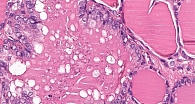 Рис. 2. NTRK-позитивная опухоль щитовидной железы