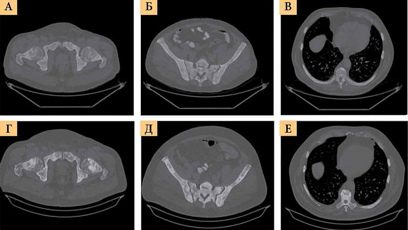 Рак 4 стадии с метастазами форум. Метастазы предстательной железы в кости кт. Компьютерная томография простаты. Кастрационно-резистентным РПЖ.