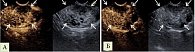 Рис. 6. ЭндоУЗИ с контрастным усилением: А – артериальная фаза, Б – венозная фаза (изображение В-режима справа, режим контрастного усиления – слева, стрелками указан наружный контур новообразования)