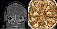 Рис. 1. Компьютерная томографическая ангиография интракраниальных артерий: окклюзия правой позвоночной артерии на интракраниальном уровне (MIP- и 3D-изображения)
