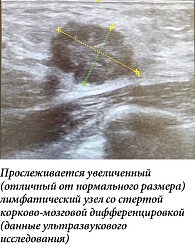 Рис. 1. Метастатический лимфоузел аксиллярной области с частичным клиническим ответом после неоадъювантной химиотерапии.