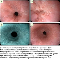 Рис. 3. Эндофотоснимок пищевода: А, Б – дистальная и средняя трети пищевода