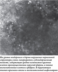 Рис. 2. Конфокальная микроскопия in vivo: