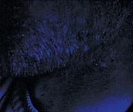 Рис. 2. Микроспория волосистой кожи подбородка, себорейная форма; свечение пораженных волос в лучах лампы Вуда