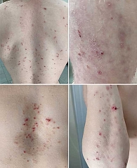 Рис. 1. Диссеминированные кожные высыпания со склонностью к группировке элементов и характерным полиморфизмом