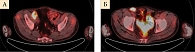 Рис. 3. ПЭТ-КТ органов малого таза (ноябрь 2019 г.): появление метастазов в подвздошных (А) и паховых (Б) лимфоузлах справа