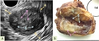 Рис. 2. Клинический случай солидной псевдопапиллярной опухоли:  А – эндосонограмма, Б – макропрепарат (а – наружный контур новообразования, б – кистозные полости, в – солидные структуры)