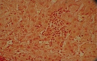 Рис. 7. Внутридольковый лимфоцитарный инфильтрат 