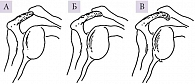 Рис. 2. Вариабельность формы акромиона: А – плоская; Б – изогнутая; В – крючковидная