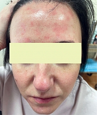 Рис. 1. Себорейный дерматит кожи лица с образованием эритематозных очагов округлой формы