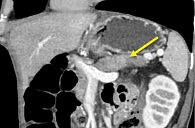 Рис. 6. Мультиспиральная компьютерная томография органов брюшной полости с контрастным усилением (контроль 1): уменьшение размеров поджелудочной железы и снижение выраженности инфильтрации парапанкреатической клетчатки