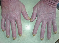 Рис. 7. Пациент В., 64 года, диагноз «псориатическая эритродермия (в течение четырех месяцев), псориатическая ониходистрофия»