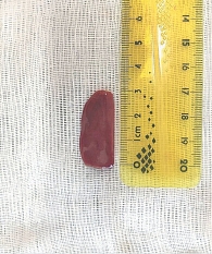 Рис. 3. Создание модели паренхиматозного кровотечения: резецированный участок печени