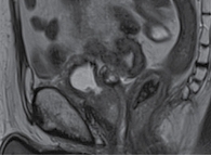 Рис. 6. МРТ малого таза на фоне терапии атезолизумабом