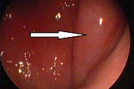 Рис. 3. Эндоскопическая картина тубарного валика после радиоволновой тубопластики через шесть месяцев. Стрелкой указан тубарный валик