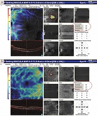 Рис. 2. Фовеолярная аваскулярная зона при начальной меланоме  хориоидеи (А) и в парном здоровом глазу (Б) (зона ФАЗ и ее параметры отмечены красным)