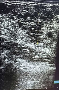 Рис. 6. УЗ-признаки фиброзно-кистозной мастопатии у 17-летней пациентки