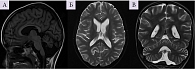 Рис. 3. Магнитно-резонансная томограмма пациентки в возрасте десяти лет в режиме Т1 (А) и Т2 (Б, В)