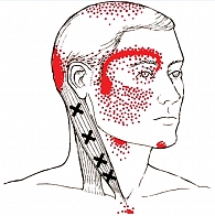 Рис. 1. Цервикогенная головная боль (возможная локализация боли выделена красными точками)