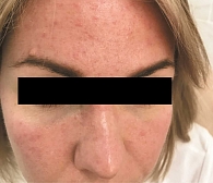 Рис. 2. Аллергическая реакция на анестетик (бензокаин) с последующим присоединением вторичной инфекции