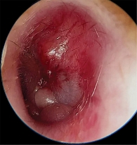 Рис. 2. Отоэндоскопия левого уха при первичном обращении
