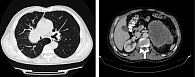 Рис. 2. МСКТ от сентября 2019 г. (до лечения). Опухоль в корне правого легкого, метастаз в левый надпочечник