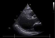 Рис. 6. ЭхоКГ пациента О. при поступлении в стационар