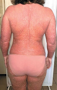 Рис. 3. Состояние при поступлении пациентки К., 40 лет, диагноз «псориатическая эритродермия»