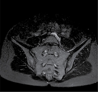 Рис. 8. Магнитно-резонансная томограмма КПС пациентки П. в августе 2021 г. (единичный очаг остеита в области правой подвздошной кости в режиме жироподавления)
