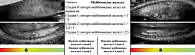 Рис. 4. Частичная атрофия, укорочение и редукция длины, снижение плотности расположения желез. Наблюдаются участки мейбогланд-дропаута (meibomian gland dropout). Контуры отдельных желез неравномерные, местами – фрагментация и дезорганизация архитектоники
