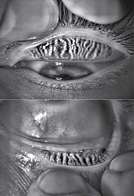 Рис. 2. Нормальная анатомия мейбомиевых желез