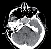 Рис. 1. КТ головного мозга. Аксиальная плоскость. Режим brain