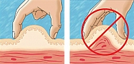 Рисунок 4. Правильное (слева) и неправильное (справа) формирование кожной складки для инъекции (инсулин или Баета)