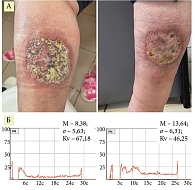 Рис. 4. Пациентка Р.: А – до и после двух курсов комплексной терапии с применением 10 процедур НАП; Б – лазерная допплеровская флоуметрия микроциркуляции той же пациентки до и после 10 процедур НАП