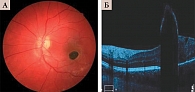 Рис. 3. Офтальмоскопия (A) и томограмма (Б) меланоцитомы