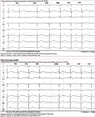 Рис. 1. Нарушение ритма и проводимости по данным ХМ-ЭКГ