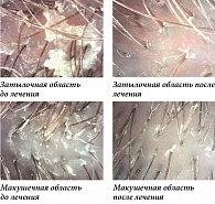 Рис. 1. Результаты трихоскопии пациентки