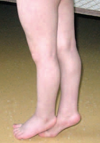 Рис. 1. Пример эквинусной установки стоп у ребенка 3 лет с диагнозом «ДЦП, спастическая диплегия»