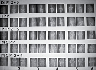 Рис. 6. Пример стандарта рентгенограмм по методу А. Larsen