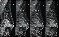 Рис. 3. Пациентка О., 46 лет. Маммограммы правой молочной железы, рак молочной железы  в виде скопления кальцинатов. 2D- (A) и 3D-изображение (B, C, D – послойные)