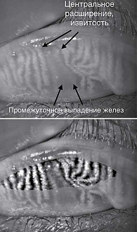 Рис. 3. Уменьшение/отсутствие нормального контраста в области мейбомиевых желез, деформация/расширение выводных протоков, что указывает на нарушение их функции или структурные изменения. Потеря мейбомиевых желез – 1/3–2/3, что соответствует стадии 2