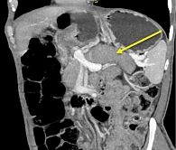 Рис. 2. Мультиспиральная компьютерная томография органов брюшной полости с контрастным усилением: увеличенная в размерах поджелудочная железа по типу «колбасообразной» (головка – 32 мм, тело – 18 мм, хвост – 24 мм)