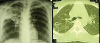 Рис. 1. Рентгенотомографическая картина инфильтративного туберкулеза верхней доли  правого легкого в фазе распада