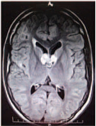 Рис. 3. МРТ головного мозга (через 48 недель приема эверолимуса)