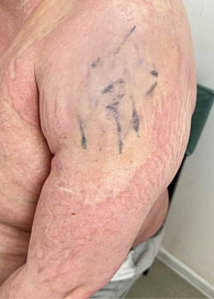 Рис. 4. Пансклеротическая склеродермия. Крупные очаги индурации на плечах, множественные стрии, атрофия кожи