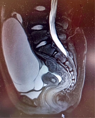 Рис. 3. МРТ-картина органов малого таза и гигантского образования, исходящего из левого яичника