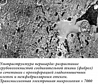 Рис. 4. Интраоперационно иссеченные участки перикарда. Ультраструктура перикарда: разрастание грубоволокнистой соединительной ткани (фиброз) в сочетании с пролиферацией гладкомышечных клеток и межфибриллярным отеком. Трансмиссионная электронная микроскопи