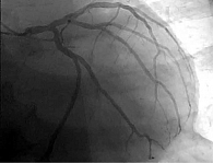 Рис. 3. Ангиография коронарных артерий пациента В.