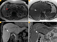 Рис. 4. Форма роста метастазов увеальной меланомы в печень: красная стрелка – инфильтративная форма роста, белая стрелка – узловая форма; DIXON (William Thomas Dixon technique) out of phase (А, Б); Т2-ВИ – коронарная плоскость (В)